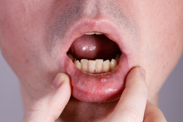 Tumor in the mouth, Mucocele lip, Stomatitis, herpes zoster, pemphigus - obrazy, fototapety, plakaty