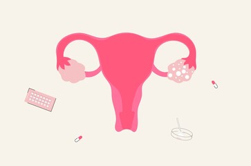 Vector illustration of polycystic ovary syndrome or PCOS
