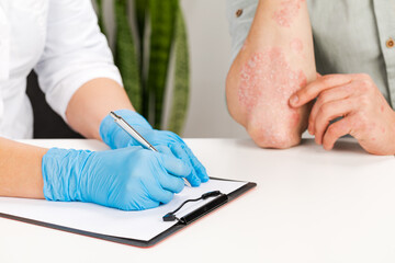 A gloved dermatologist examines the skin of a sick patient and records observations. Examination and diagnosis of skin diseases-allergies, psoriasis, eczema, dermatitis