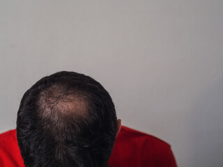 Fighting hair loss in men. Baldness, man worried about hair loss. Baldness concept