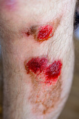 A man's red, bloody, painful leg injury from a fall while sport. Sports injury concept for first...