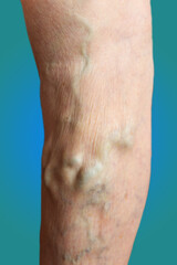 Naklejka premium The old age and sick of a woman. Varicose veins on a legs of old woman on blue. The varicosity, spider veins, edema, illness concept. Senior pensioner woman with hands on legs. Blue studio background.