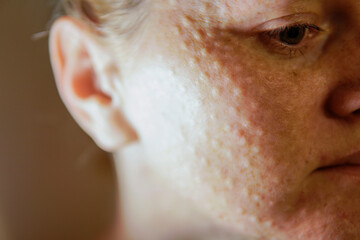 Woman's face after mesotherapy injections biorevitalization. beauty injections