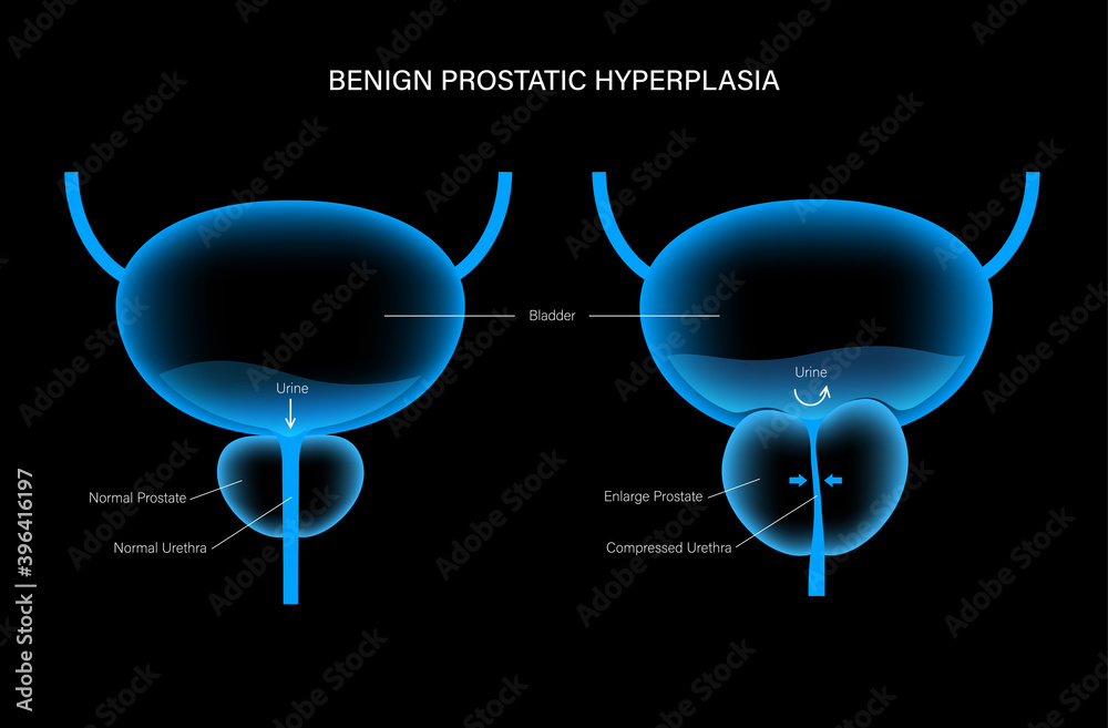 Sticker BPH info concept