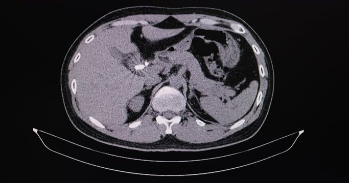 Cineview of CT scan of a patient with common bile duct stone.