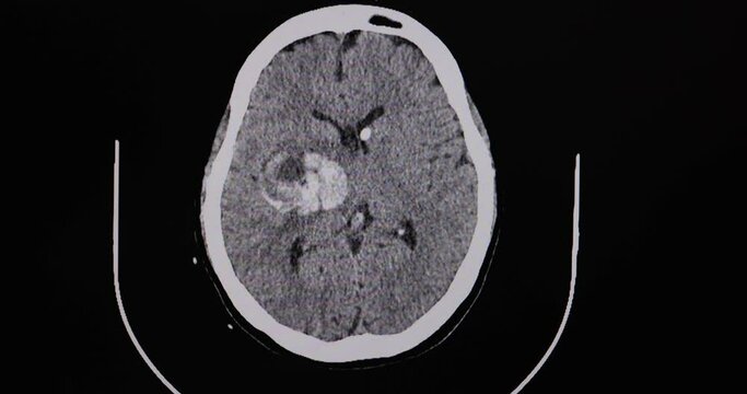 A CT cinescan of a stroke patient showing bleeding in the right basal ganglion.
