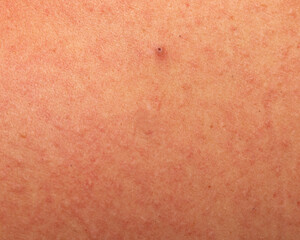 Fototapeta premium redness on the skin in the form of a rash as a background