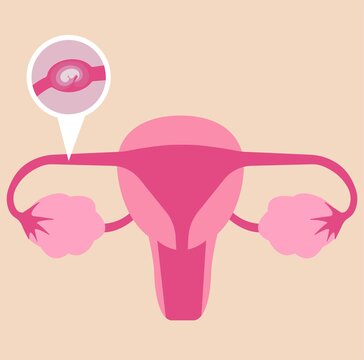 Ectopic pregnancy or fallopian tubes pregnancy.