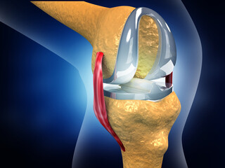 Human knee replacement implant. 3d illustration. - obrazy, fototapety, plakaty