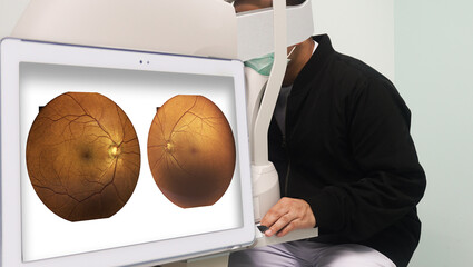 Patients are examining their eyesight with a fundus non-mydriatic camera in a screening room for patients at risk of diabetes.