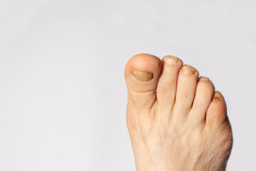 Fungus of nails on the big toe - dermatomycosis and onychomycosis, fungal infection macro photo. Dermatology, treatment of nail mycosis.