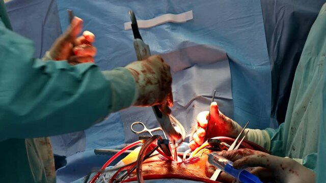 Team of surgeons in hospital open heart surgery in operating room