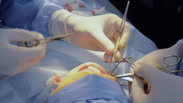 Surgeon do buccal fat removal. Bisha lumps removal. Plastic surgery in clinic