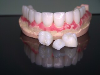 Obraz premium Macro shot of beautiful teeth. Zirconia crowns on the diagnostic model of the upper jaw against a dark background with reflection