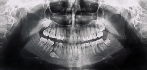 x-ray of the mouth with a problem tooth
