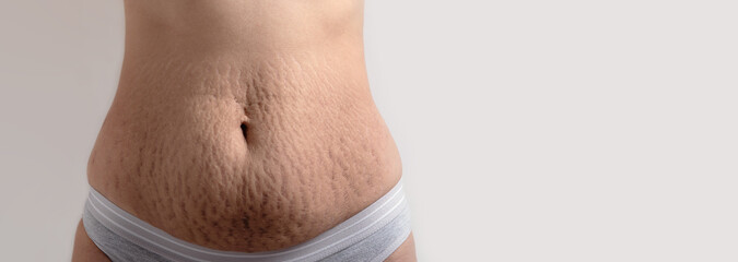 skin stretch marks on female belly