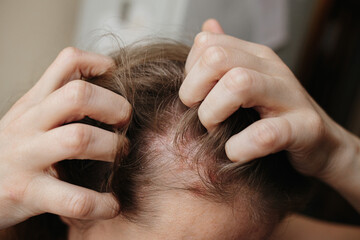 Psoriasis Vulgaris, psoriatic skin disease in head hair, skin patches are typicaly red, itchy, and scaly. Woman furiously scratching her head