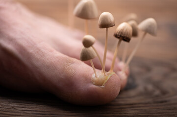Fungi grow from the nail plates on the foot. Concept of nail fungus, skin and nail infections. Foot with fungus close-up in the background light.