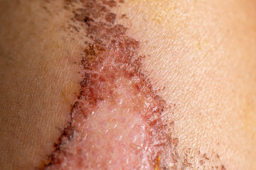 Fototapeta premium Closeup injured, Fresh wounds from accident. 