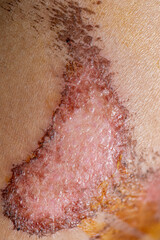 Fototapeta premium Closeup injured, Fresh wounds from accident. 