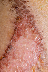 Fototapeta premium Closeup injured, Fresh wounds from accident. 