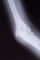 x ray, childs ulna fracture, close up