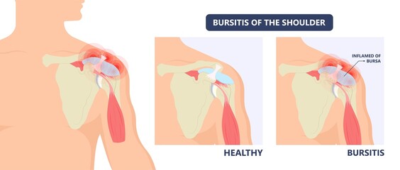 Hip pain knee heel cuff bone gout drug Feet bursa joint elbow treat tears drain shots fluid Ankle bursae tendon muscle trauma injury septic frozen tennis therapy rotator disease greater relieve