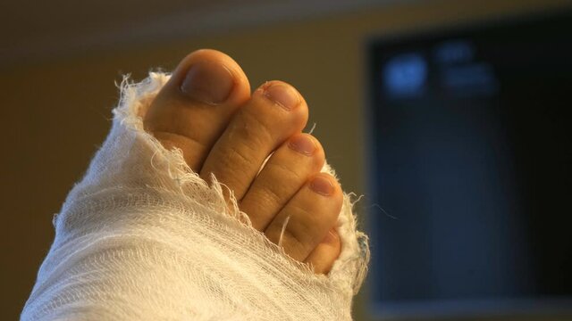 male leg in a plaster cast. toes moving. Against the background of the TV, close-up.