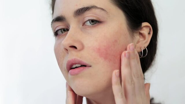 Close-up portrait of a young woman groping her face and showing redness on her cheeks. White background. The concept of rosacea and couperose