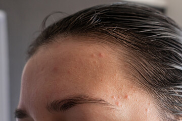 Obraz premium Close-up portrait of a girl squeezes out a pimple on her forehead. An awkward moment before a date