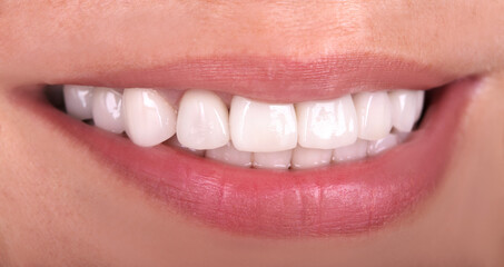 Perfect healthy teeth beautiful wide smile bleaching ceramic crowns whitening of young smiling...