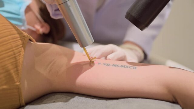 4K footage of Laser tattoo removal treatment on female arm in clinic