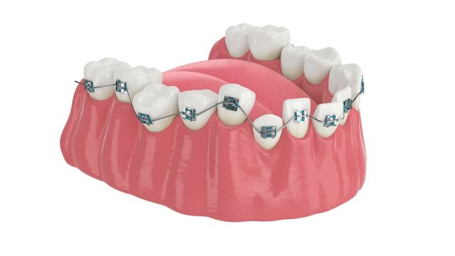 Teeth alignment by orthodontic braces isolated over white background