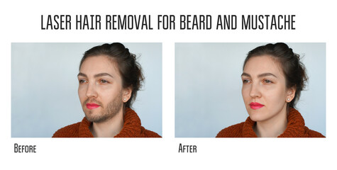 laser hair removal for beard and mustache
