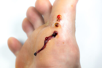 Wounds with blood from removal of warts. Black scars. Contagious skin illness on foot. Medical...