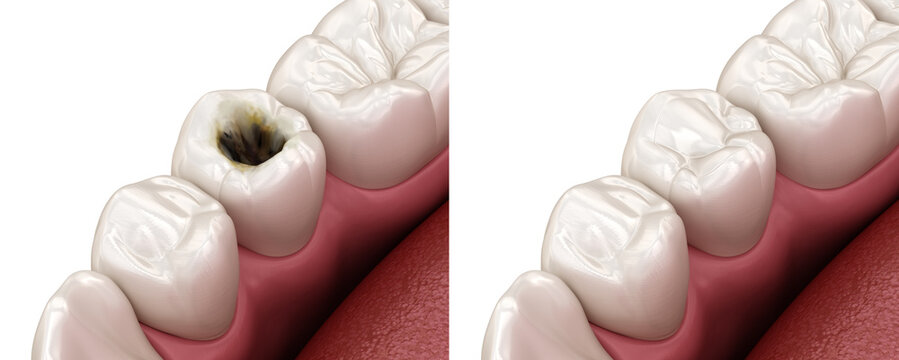 Premolar tooth restoration with filling after caries damage. Medically accurate tooth 3D illustration.