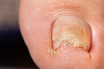 Fototapeta premium Ingrown toenail from wearing tight shoes. Nail fungus macro photo, onychomycosis, dermatomycosis, mycosis