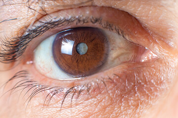 Macro photos of the human eye - cataract clouding of the lens, deterioration of vision. Treatment, surgery and ophthalmology