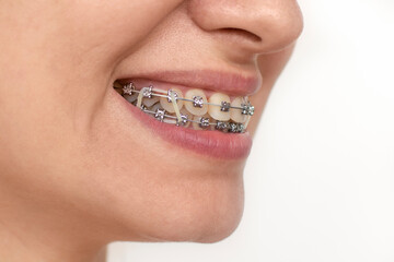 Closeup of woman with braces on teeth with elastics. Smiling face with braces isolated on white background. Orthodontic treatment. Closeup of healthy female mouth with metal braces. 