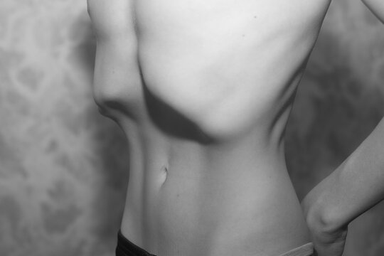 a child with Anorexia. sunken belly