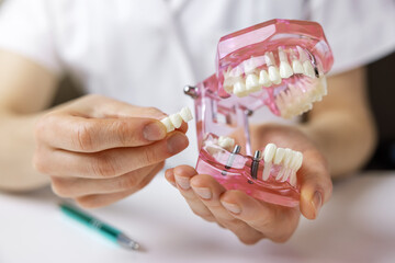 dentist implantologist showing dental bridge implant technology on human tooth jaw model - obrazy, fototapety, plakaty