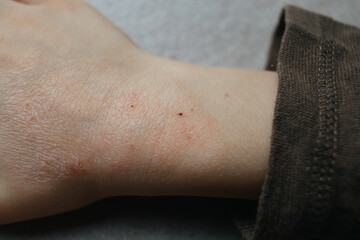 children hand with atopic dermatitis. eczema on hand. psoriasis on kids hands