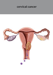 자궁경부암 설명을 위한 메디컬일러스트