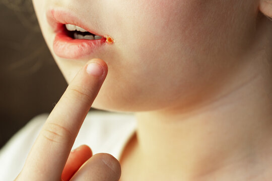 herpes, zoster, lips.  corner mouth