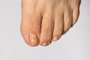 Fungus of nails on the big toe - dermatomycosis and onychomycosis, fungal infection macro photo....