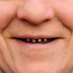 Close-up of a woman's face with rotten and dying teeth