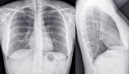 Woman chest x-ray. Frontal and lateral view.