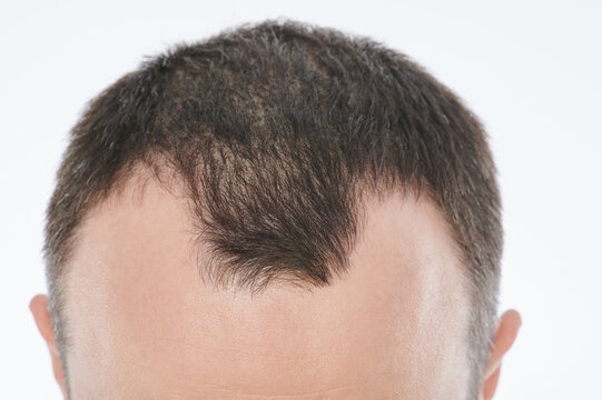 Hairloss in young age theme
