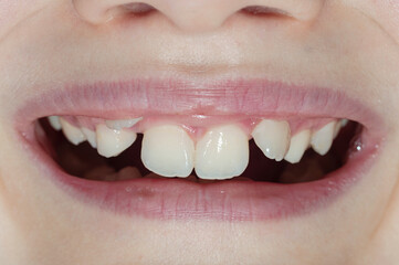 Obraz premium Smile of a boy with teeth growth defects.