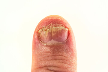The thumb nail affected by the fungus is isolated on a white background